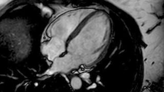 MRT-Aufnahme des Herzens, ein so genannter 4-Kammerblick (Universitätsklinikum Heidelberg)