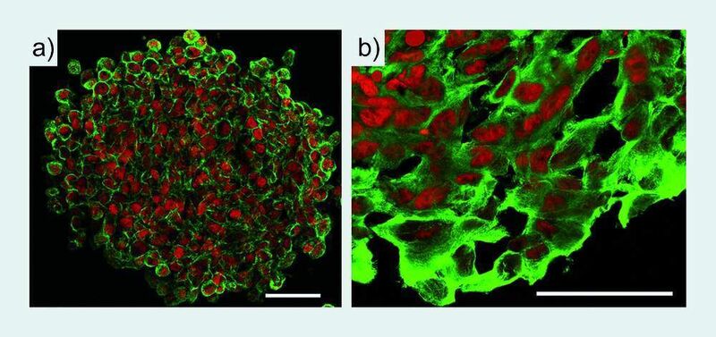 3 Immunzytochemische Färbungen von Melanomzellaggregaten an Kulturtag 4; (a) Expression des membranständigen Hyaluronsäure-Rezeptors CD44 (grün), Zellkerne rot (Gefrierschnitt), (b) Verteilung von a-Tubulin im Zytoplasma (grün), Zellkerne rot (Gefrierschnitt); Balken = 50 µm. (Archiv: Vogel Business Media)