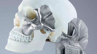 Der Medizintechnik-Hersteller Conmet produziert mit einem 3D-Drucker von Trumpf Schädel- und Kieferimplantate. (Trumpf)