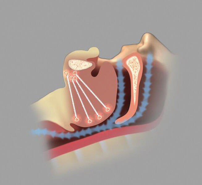 Durch eine Art Federwirkung der Implantate wird der Zungengrund leicht nach vorn positioniert. Das schafft hinter der Zunge Raum für die Atemwege und für eine freie Atmung.  (Revent Medical, Inc.)