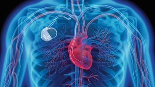 Elektronische Implantate: Mit der Energie aus den menschlichen Zellen sollen sich künftig auch Herzschrittmacher energieautark betreiben lassen. (©peterschreiber.media - stock.adobe.com)