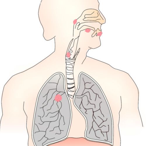 Lung cancer, the most common cancer worldwide, is targeted with radiation therapy in nearly one-half of cases. Lung cancer, the most common cancer worldwide, is targeted with radiation therapy in nearly one-half of cases.