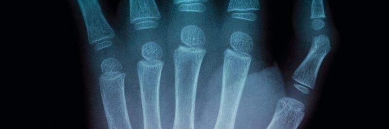 Das nach dem deutschen Physiker Wilhelm Conrad Röntgen benannte bildgebende Verfahren findet seit über 120 Jahren regelmäßige Anwendung in aller Welt.(©  SLX)