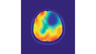 Die rote Linie markiert das Tumorareal; der farbige Kontrast zeigt den Sauerstoff-Stoffwechsel an. Wie vom Warburg-Theorem vorhergesagt, ist der Sauerstoff-Umsatz im Tumor reduziert (blau). (Bild: © Paech / Radiology)