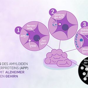 So läuft die APP-Spaltung in einem mit Alzheimer befallenen Gehirn ab. Die nicht abgebauten Proteinreste führen zum Absterben der Zelle.(Bild:  Agentur der RUB)
