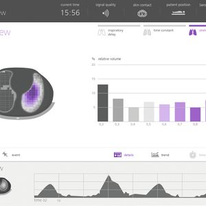 Die Lufu-View visualisiert, wie häufig einzelne Parameterausprägungen in verschiedenen Lungenregionen vorkommen.