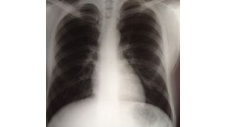Röntgenaufnahme der Lunge (Bild: ILL)