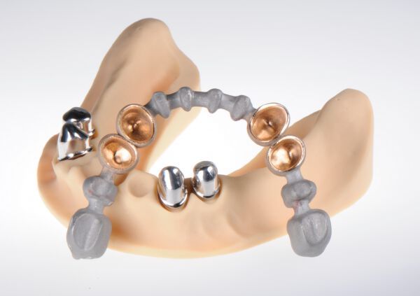 Ein Preisgeld in Höhe von 2500 Euro in der Kategorie MedTech geht an das Team von  Fidentis, eine Ausgründung aus dem Fraunhofer IGCV. Sie haben einen additiven Multimaterial-Prozess für Teleskopprothesen entwickelt, welcher die gleichzeitige Verarbeitung verschiedener Metalle in einem einzigen Baujob ermöglicht. In enger Zusammenarbeit mit führenden Zahnärzten und Zahntechnikern wurde das neue Verfahren für die Herstellung von Teleskopen perfektioniert. Die Prothesen werden in einer automatisierten, durchgängig digitalen Prozesskette gedruckt und nachbearbeitet. Nach dem Aufbringen einer Verblendung ist die Prothese einsatzbereit. FIDENTIS spart 60 % der Produktionskosten und macht den hochwertigsten Zahnersatz für jedermann erschwinglich.   (Bild: 3DPC)