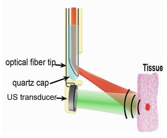 Abb. 5: Funktionsprinzip eines intravaskulären Katheters, der die vom OPO erzeugten Laserpulse über eine Glasfaser in das Blutgefäß und an die zu untersuchende Stelle leitet und mittels eines Miniatur-Ultraschalldetektors die Antwort des Gewebes aufnimmt.(Bild:  TU Eindhoven)