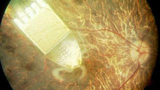 Trägersubstrat für ein Retina-Implantat, da teilweise das Augenlicht wiederherstellen soll (Archiv: Vogel Business Media)
