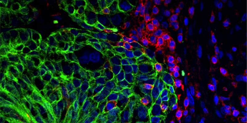 Wie Tumorzellen sich verbreiten  Wie sich Tumorzellen bei der Metastasierung verändern, hängt von bestimmten Molekülen auf der Zelloberfläche ab. Frühere Studien haben gezeigt, dass eine bestimmte Klasse von Molekülen hier einen entscheidenden Beitrag leistet: die Glykolipide. Sie bestehen aus einem Zucker- und einem Fettanteil, kommen auf jeder Zelloberfläche vor und sind in verschiedenste zelluläre Kommunikationsprozesse involviert. Die Bedeutung der Glykolipide bei der Ausbreitung von Eierstockkrebs hat ein internationales Team unter Basler Leitung entschlüsselt. Die Erkenntnisse könnten den Weg für neue Therapieansätze ebnen. Das Bild zeigt die Gewebeprobe eines Ovarialkarzinoms: Tumorzellen sind grün, Immunzellen rot und Zellkerne blau gefärbt.  Hier gehts zur Originalmeldung Wissenschaftsbild des Tages vom 30.8.2022  (Ricardo Coelho, Universität Basel / Universitätsspital Basel)