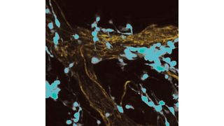 Die Immunfluoreszenzmikroskopische Aufnahme von UV-bestrahltem, entzündetem Hautgewebe zeigt grün fluoreszierende Melanomzellen, die sich auf rot fluoreszierenden Oberflächen von kleinen Blutgefäßen ausbreiten. (Bild: Tobias Bald/UKB)