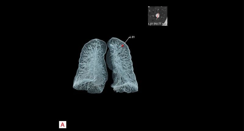 Eine durch AI-Rad Companion Chest CT aufbereitete Lungenaufnahme (rot markiert einen Lungenknoten mit automatischer Vermessung). (Siemens Healthineers)