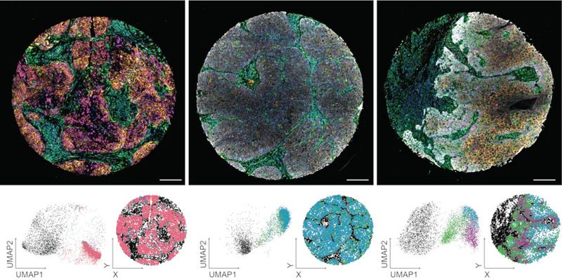 Bildgebende Diagnostik von Kopf- und Halstumoren  Krebserkrankungen des Kopfes und Halses gehören weltweit zu den zehn häufigsten Krebsarten. Ein internationales Forscherteam unter der Leitung von Sara Wickström hat nun eine neue Technik entwickelt, mit der die Eigenschaften von Krebszellen und des sie umgebenden Gewebes auf der Ebene einzelner Zellen genau analysiert werden können. Gezeigt sind Beispiele für Patientenbiopsien, die mit einer Reihe fluoreszierender Antikörper angefärbt wurden (obere Felder). Durch die Extraktion der Fluoreszenzintensitäten zusammen mit den morphologischen Merkmalen von Zellen und Gewebe kann eine multiparametrische Beschreibung jeder Zelle im Gewebe erstellt werden (unten links; jeder Punkt im Feld steht für eine einzelne Zelle). Durch die Gruppierung dieser Zellen auf der Grundlage ihrer Ähnlichkeit werden patientenspezifische Fingerabdrücke erstellt (unten rechts).  Hier gehts zur Originalmeldung Wissenschaftsbild des Tages vom 31.10.2024  (Bild: Universität Helsinki / Karolina Punovuori)