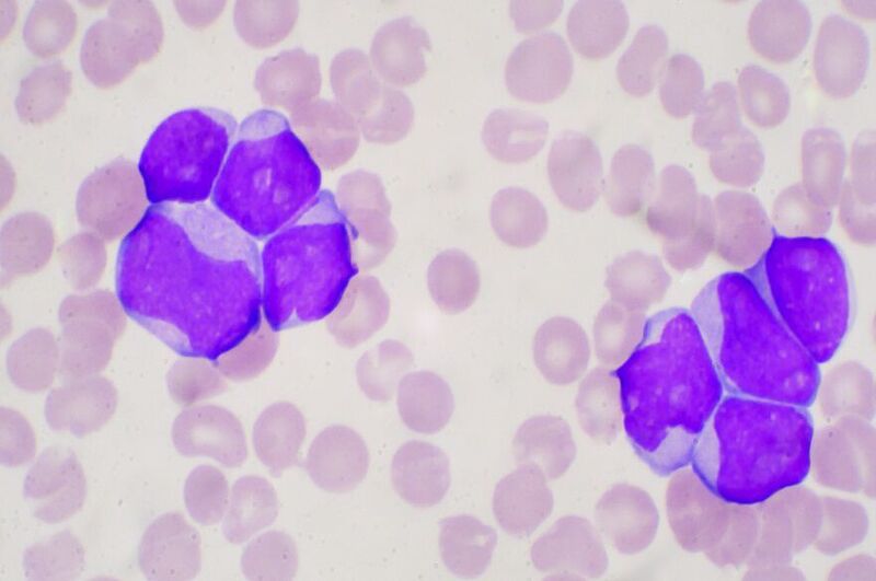 It is hoped that the findings will pave the way for new and more personalised therapies for acute myeloid leukaemia. (Getty Images )