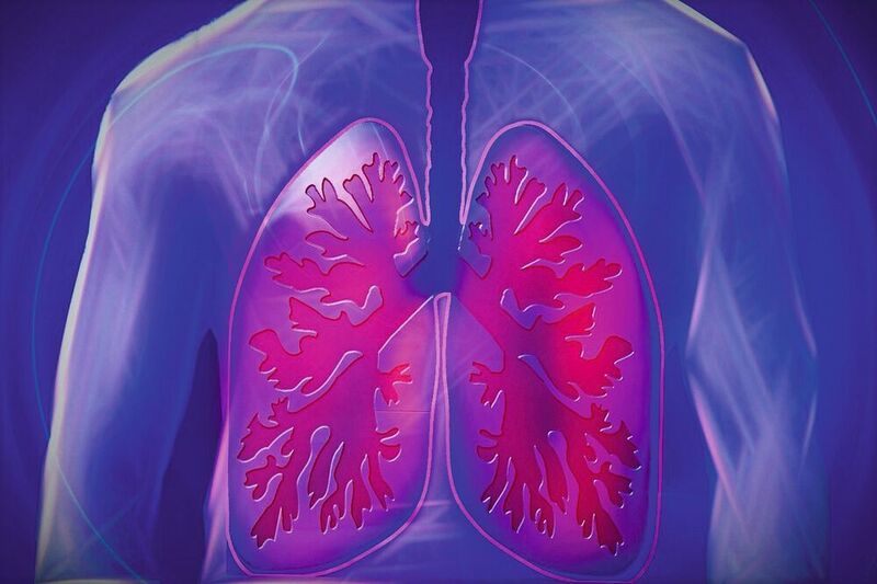 Lungenfibrose ist eine Lungenkrankheit, bei der das Gewebe der Lunge vernarbt.  Atembeschwerden sind die Folge. (Symbolbild) (Pixabay/kalhh)