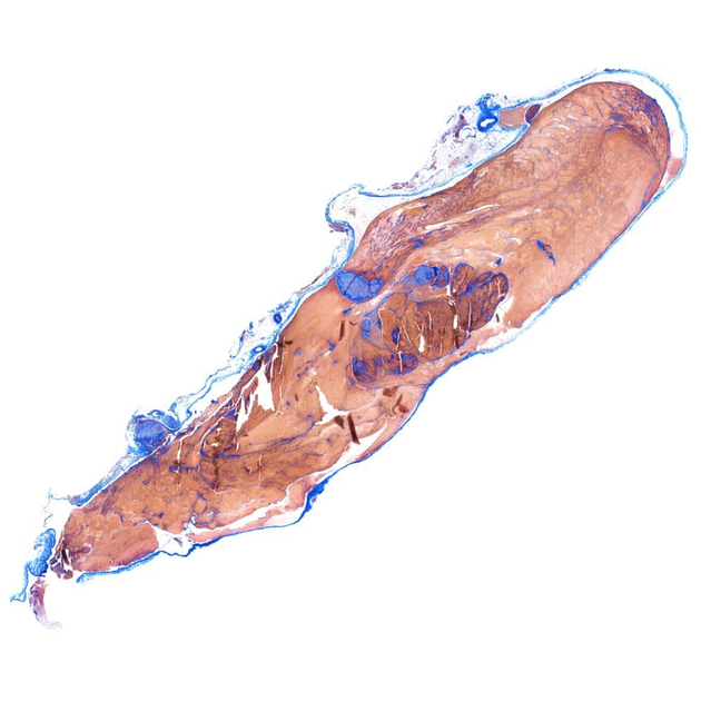 Eisenmangel Risikofaktor Bei Thromboseneigung