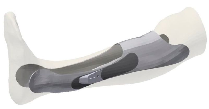 Digitaler Entwurf des individuell angepassten Orthesenprototyps. (Bild: Artec)