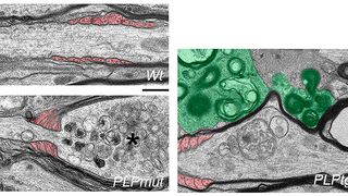 Elektronenmikroskopische Aufnahmen von Axonen in der weißen Substanz von gesunden Kontroll-Mäusen (links oben) und von Mäusen mit verschiedenen Myelin-Gendefekten. Axone, die mit abnormem Myelin umwickelt bleiben (links unten), werden von Fortsätzen der Oligodendrozyten (rot gefärbt) eingeschnürt und weisen Merkmale der Degeneration auf (Stern). Im Gegensatz dazu haben Axone, deren Myelin durch Mikroglia (grün gefärbt, rechtes Bild) entfernt wird, eine höhere Chance zu überleben. Größenmaßstab: 0,5 µm. (Bild: Janos Groh, © Springer Nature)