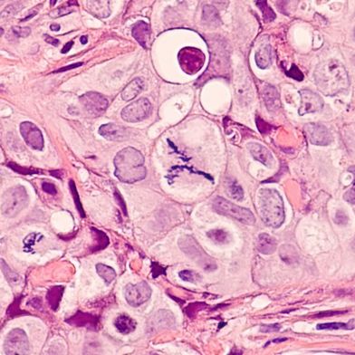 Abb. 1: Neu entwickelte lichtaktivierbare Nanopartikel zeigten in biologischen Untersuchungen eine starke Aktivität gegen verschiedene Tumorzelllinien. (Symbolbild) (Bild: © David A Litman - stock.adobe.com)