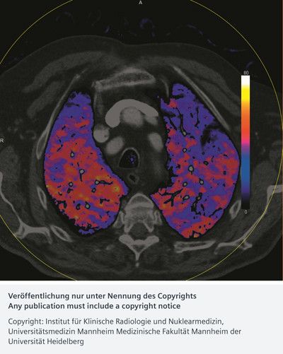Mittels Dual Energy CT dargestellte Lungenperfusion (PBV, Kontrastmittelmenge: 55 ml) mit einer Akquisitionslänge von 32 cm und einer Aufnahmedauer von 4 Sekunden bei 90 / Sn 150 kV. Obwohl keine Lungenarterienembolie nachgewiesen werden konnte, zeigte sich ein im linken oberen Lungenlappen gelegener keilförmiger Perfusionsdefekt. Durch spektrale Zerlegung ergab sich eine bessere Bildqualität. (Bild: Institut für Klinische Radiologie und Nuklearmedizin, Universitätsmedizin Mannheim)