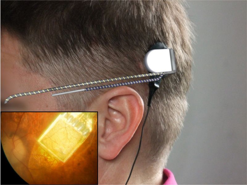 Ein ultradünnes Kabel wird vom Chip im Auge entlang der Kopfseite hinter das Ohr des Patienten verlegt. Dort befindet sich der Anschluss für das Steuergerät. (Bild: Retina Implant)