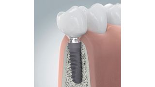 Altatec ist Teil der weltweit operierenden Camlog-Gruppe und fertigt Zahnimplantat-Systeme. Das sind unterschiedliche Artikel und macht in der Summe über 3,5 Mio. Werkstücke pro Jahr. (Bild: Altatec)