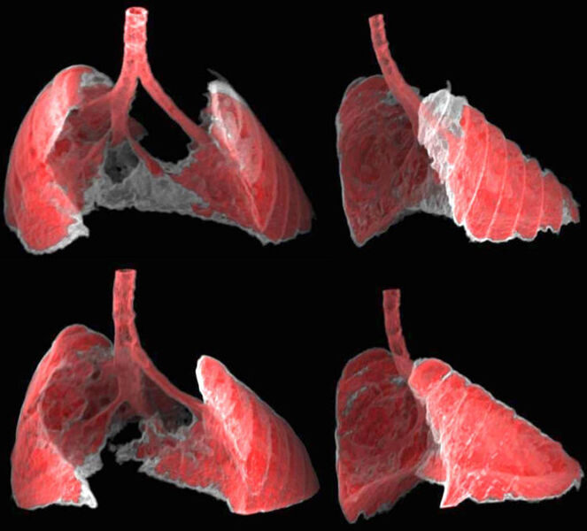 The figure shows two views, frontal and lateral, of the image obtained by CT of the lungs of a mouse with fibrosis (grey areas) before and after receiving nano-therapy directed at senescent cells. (Guillem Garaulet and Francisca Mulero, CNIO)