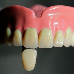 Monolithische Zahnprothese aus dem 3D-Drucker: Mit einem biomimetischen Multi-Material-Workflow zeigt das Fraunhofer IGD, wie natürlich wirkende Ästhetik durch digital eingebettete Schichten aus Schmelz, Dentin und Zahnwurzel erzielt wird.(Bild:  Fraunhofer IGD)