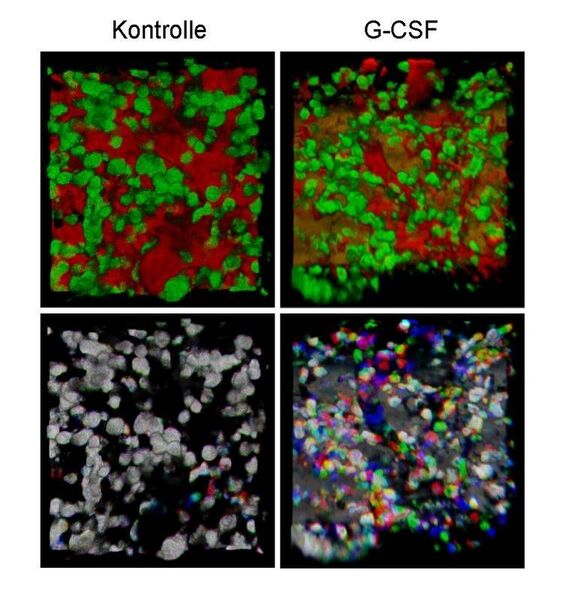 Der Wachstumsfaktor G-CSF bewirkt die Mobilisierung von Zellen des Immunsystems. Das belegen die mikroskopischen Videosequenzen von Immunologen des Magdeburger Universitätsklinikums. (Ausschnitt) Zu sehen sind in der oberen Reihe grün gefärbte neutrophile Granulozyten im Knochen. Die Blutgefäße sind rot und die harte Knochensubstanz braun. In der unteren Reihe sind die gleichen Zellen so dargestellt, dass man erkennen kann, ob sie sich bewegen oder nicht. Weiße Zellen sind unbewegt, bunte Zellen haben sich bewegt. Man erkennt, dass sich nach der Zugabe von G-CSF die Granulozyten deutlich mehr bewegen als unter Kontrollbedingungen. Dies ist die Ursache für ihre Mobilisierung aus dem Knochenmark ins Blut. (Bilder: Gunzer/Köhler: Universitätsklinikum Magdeburg) (Archiv: Vogel Business Media)
