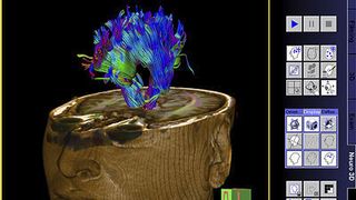 Erfindung von Dr. Thorsten Freiweier: Diffusionsbildgebung mittels Magnetresonanztechnologie ist besonders schonend für Patienten, aber die Bilder waren bisher schwer zu interpretieren. Dank der Entwicklungen von Dr. Thorsten Feiweier sind Diffusionsbilder jetzt so präzise, dass beispielsweise Durchblutungsstörungen nach einem Schlaganfall sehr genau erkannt werden können.   Bilder: Siemens (Archiv: Vogel Business Media)