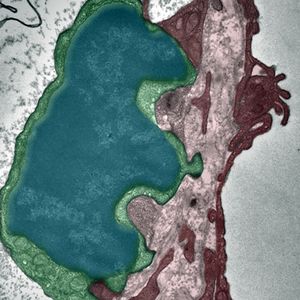 Abb. 1: Eine Tumorzelle (blaugrün) lässt sich mit Hilfe des CCR2-Rezeptors durch ein Blutkapillargefäss in der Alveole (violett) schleusen. Der vorgestülpte Teil der Tumorzelle ist gerade dabei die Endothelzelle zu durchwandern. (Elektronenmikroskopische Aufnahme)