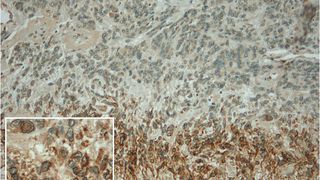 Im Hirntumorgewebe kann der Dioxin-Rezeptor AHR (braun) in denselben Arealen wie das Enzym TDO nachgewiesen werden.
(Färbung: Felix Sahm, Abteilung Neuropathologie, Universitätsklinikum Heidelberg)  (Bild: Nature)