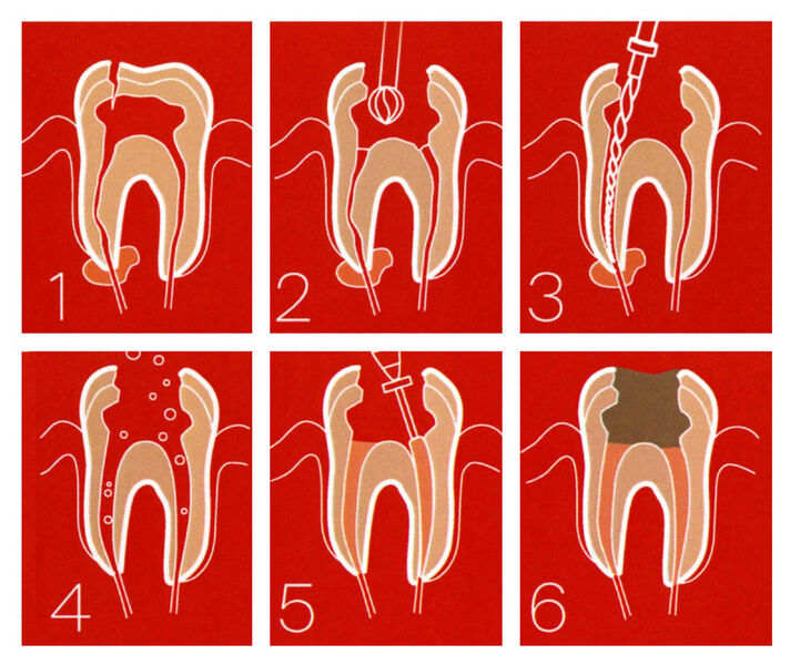 Les six étapes d'un traitement endodontique réalisé avec des instruments Dentsdply Maillefer. (Image: Dentsply Maillefer)