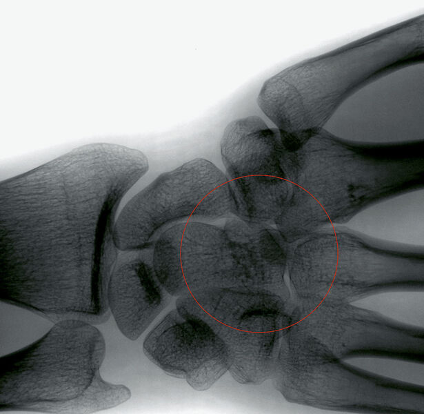 Abb.5a: Klassische Anwendung: Kontrolle von Knochenheilung. (Archiv: Vogel Business Media)