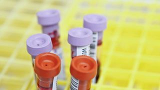 Künftig könnte der Elecsys pTau181 Bluttest genutzt werden, um Alzheimer anhand von Blutproben auszuschließen. (Symbolbild) (Bild: frei lizenziert/ National Cancer Institute)