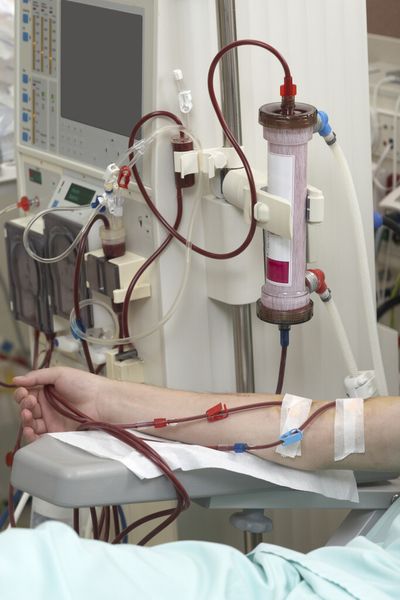 Während der Dialyse wird das Blut von Patienten durch Schläuche geleitet, die aus einer semipermeablen Membran bzw. einem Filter bestehen. Dieser hält die Blutbestandteile zurück, aber lässt die Giftstoffe passieren. So werden sie abgeschieden. (Bild: GGB)