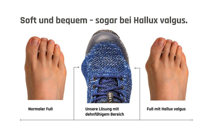 Diese Darstellung veranschaulicht, welche Vorteile der Schuh „Sky“ von Baak auch den von Hallux valgus geplagten Menschen bietet.