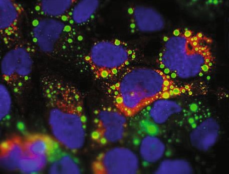 HCV-infizierte Zellen: An den grünen Fetttröpfchen werden die Viren zusammengebaut. (Bild: TWINCORE/ Pietschmann)