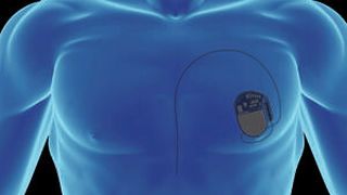 Software im sicherheitskritischen Umfeld: Steuert Software beispielsweise einen Herzschrittmacher, dann gibt es keine Kompromisse (Bild: iStock)