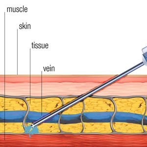 Abb.1: Illustration einer Paravasation