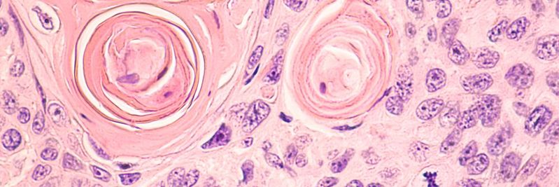 Mikroskopische Aufnahme einer CT-gesteuerten Nadelkernbiopsie, die ein pulmonales Plattenepithelkarzinom zeigt, eine Art von nicht-kleinzelligem Karzinom, das in der Regel mit dem Rauchen in Verbindung gebracht wird. Mikroskopische Aufnahme einer CT-gesteuerten Nadelkernbiopsie, die ein pulmonales Plattenepithelkarzinom zeigt, eine Art von nicht-kleinzelligem Karzinom, das in der Regel mit dem Rauchen in Verbindung gebracht wird.