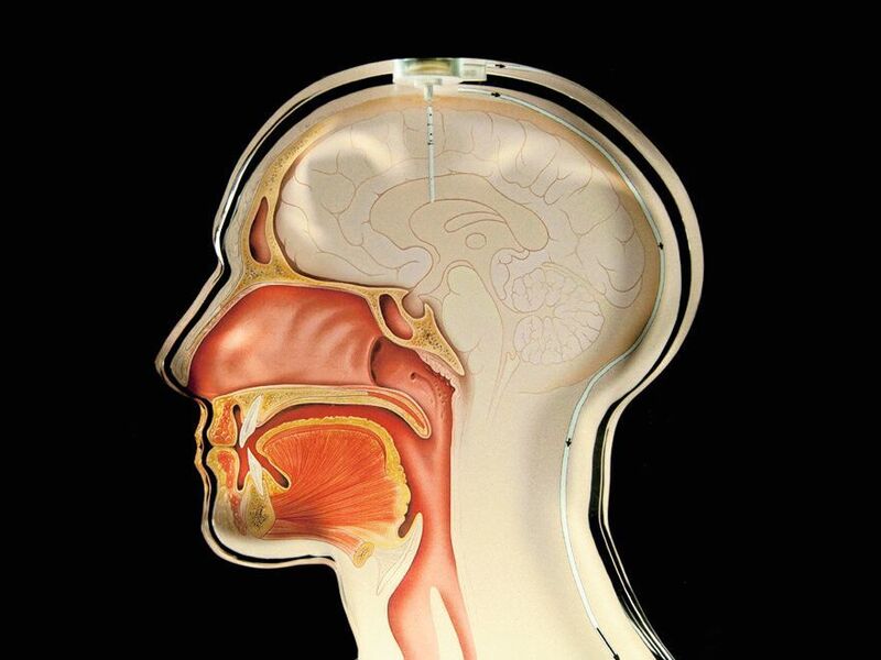 Ein Hirndrucksensor zur Überwachung der Shunt-Funktion bei Hydrozephalus-Patienten:
schematische Darstellung des Implantationsortes innerhalb des Kopfes. (Fraunhofer IMS)