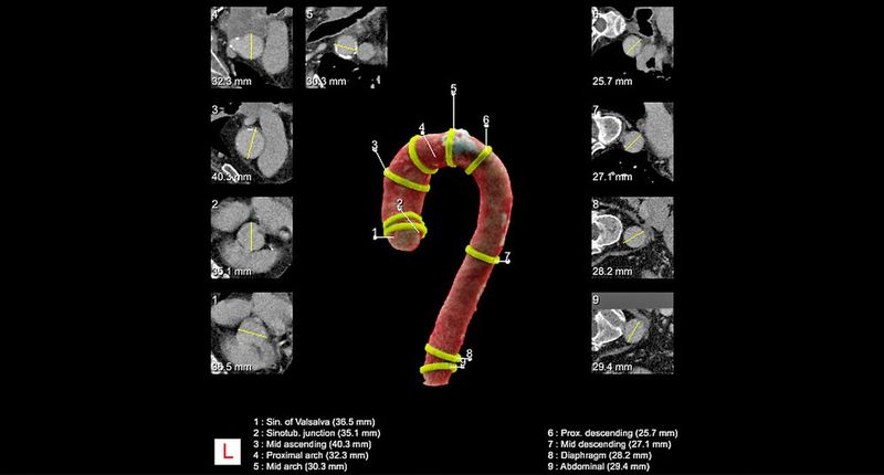 Leitliniengerechte Vermessung an mehreren Gefäßabschnitten der Aorta durch AI-Rad Companion Chest CT. (Bild: Siemens Healthineers)