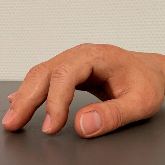 Schubert + Braun Prothesenwerke Dresden schließt mit seinen passiv beweglichen Prothesen die Lücke zwischen Funktion und kosmetischem Erscheinungsbild. Schubert + Braun Prothesenwerke Dresden schließt mit seinen passiv beweglichen Prothesen die Lücke zwischen Funktion und kosmetischem Erscheinungsbild.