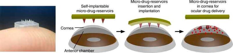 The eye patch for ocular drug delivery is equipped with an array of self-implantable micro-drug-reservoirs. (NTU Singapore)