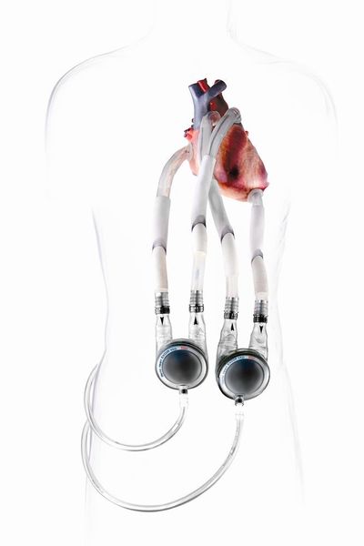 Eine „exotische“ und anspruchsvolle Anwendung: In diesem Herzunterstützungssystem drücken NSK-Miniatur-Kugelgewindetriebe gegen die im Bild sichtbare Membran und simulieren damit die Kontraktion des menschlichen Herzens. (Berlin Heart)