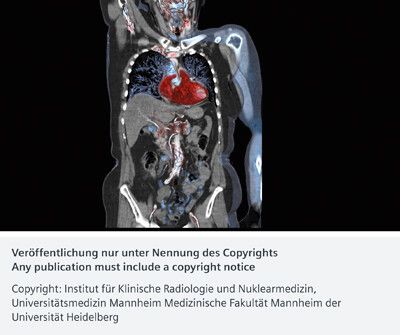 CT-Scan einer Länge von 63 cm mit niedriger Gesamtdosis von 1,9 mSv, durchgeführt mit dem Turbo Flash Mode in nur 1.2 s, bei 80 kV und einem Pitch von 2.4. Die Bildqualität ist sehr gut, obwohl der linke Arm des Patienten im Scanbereich verbleiben musste. (Bild: Institut für Klinische Radiologie und Nuklearmedizin, Universitätsmedizin Mannheim)
