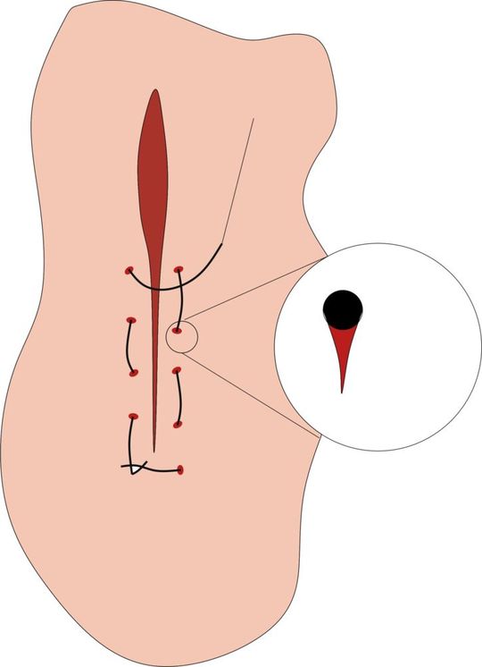 Weiches Gewebe kann durch die im Vergleich zum Gewebe sehr feste Naht beschädigt werden. Die Verwendung von TPU reduziert das Einschneiden der Naht in die Patientenhaut.(Bild:  ITA)
