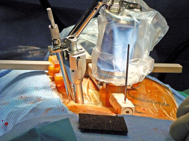 Das SpineAssist-System macht Eingriffe zur Wirbelsäulenfusion mit nur wenigen kleinen Einschnitten möglich.  (Bild: Faulhaber)